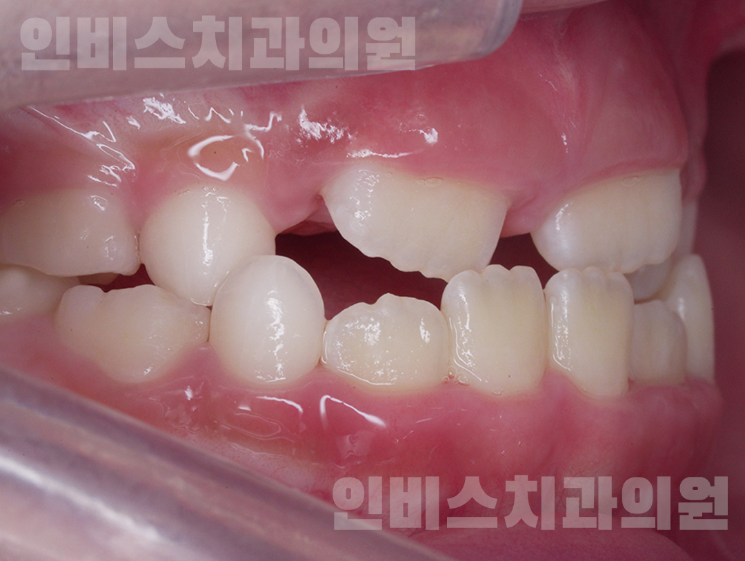 창원 투명교정 전