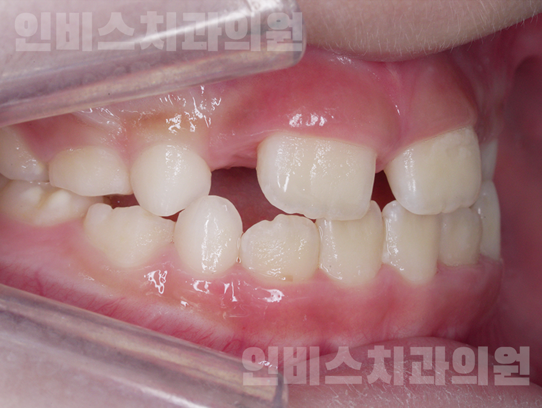 창원 투명교정 후