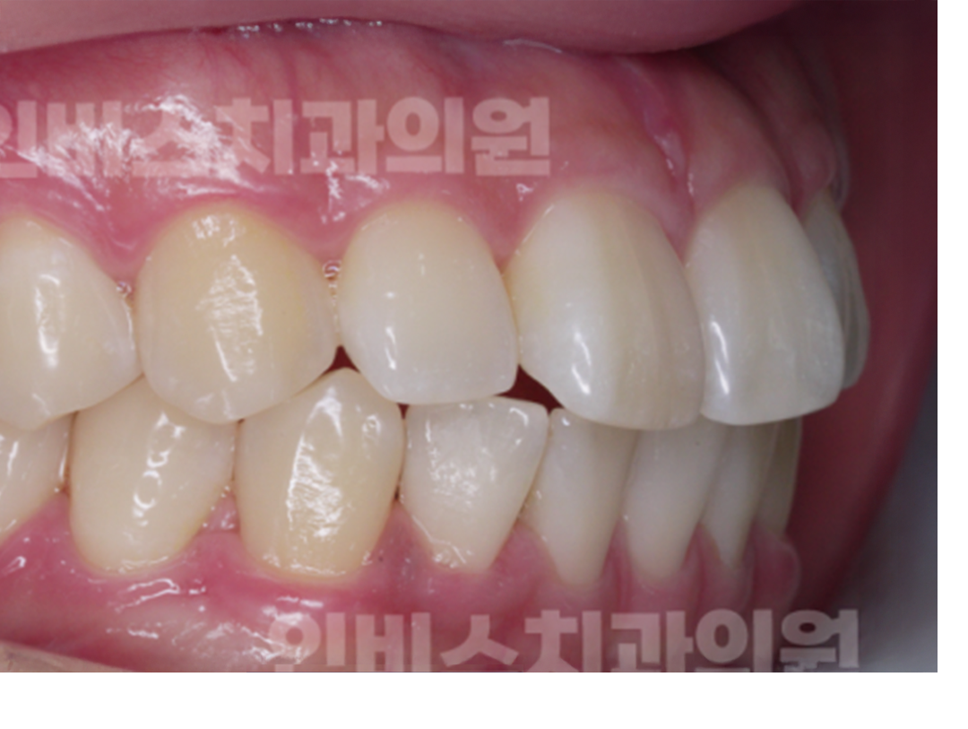 마산 부분교정 전