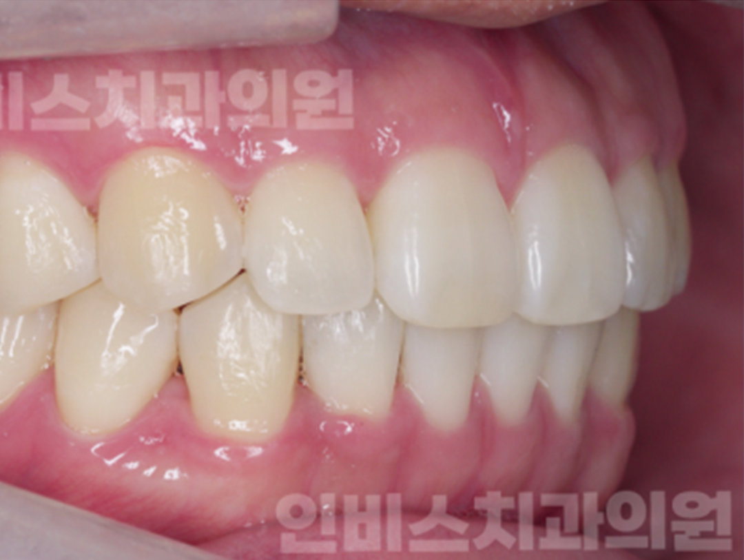 마산 부분교정 후