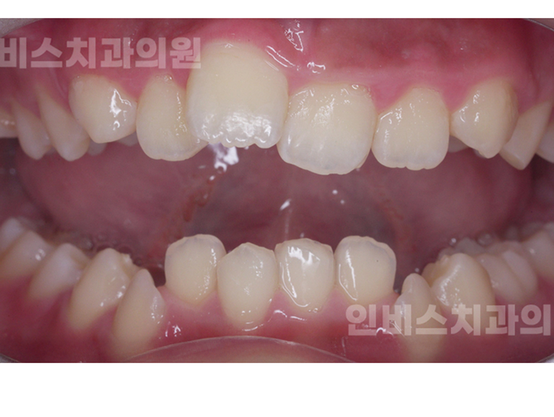 창원 교정치과 교정 전