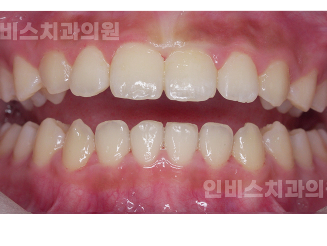 창원 교정치과 교정 후