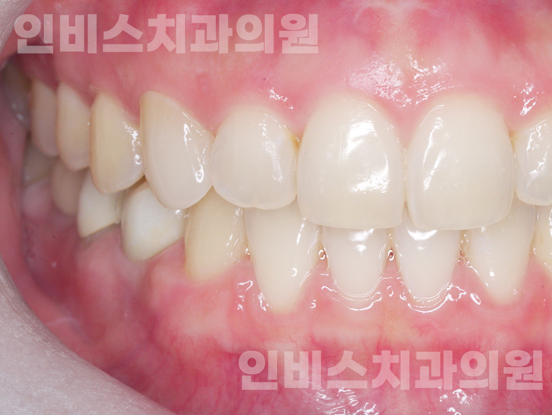 무삭제 라미네이트 후 1