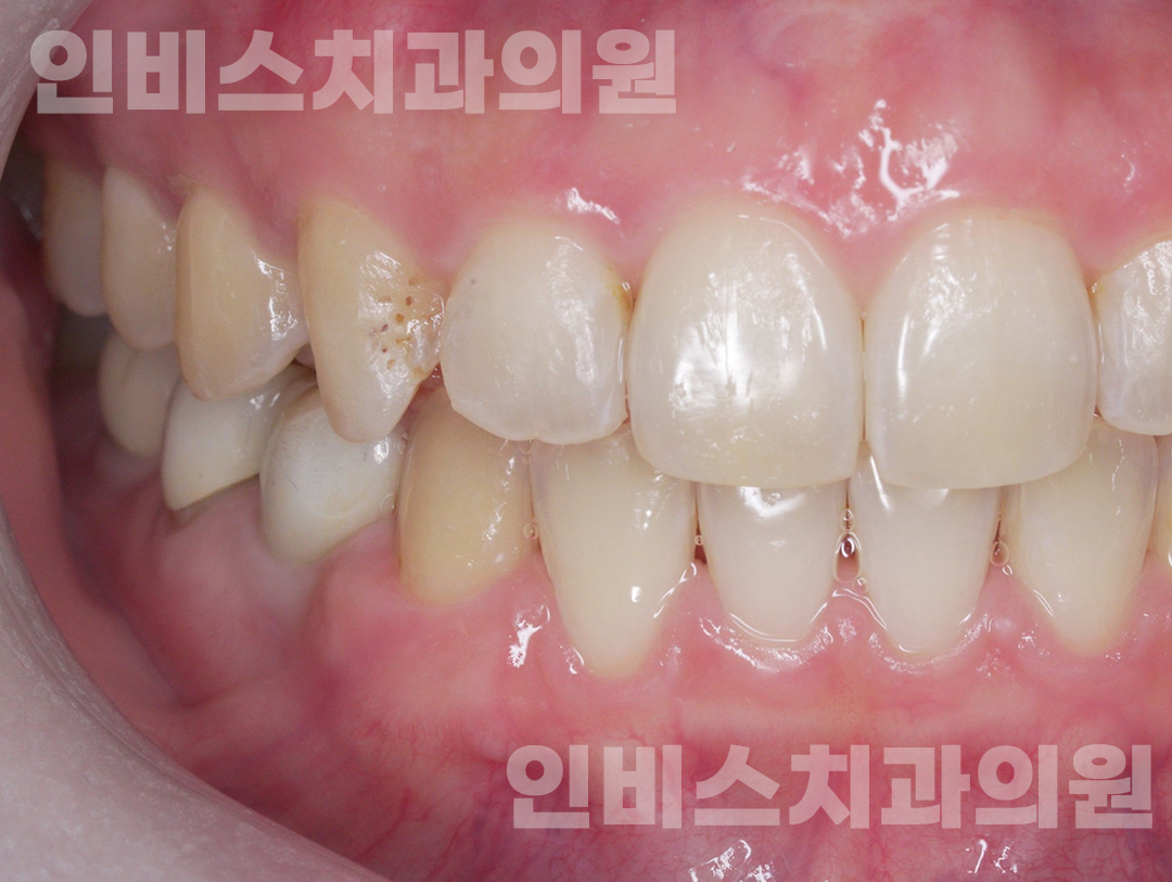 무삭제 라미네이트 전 1