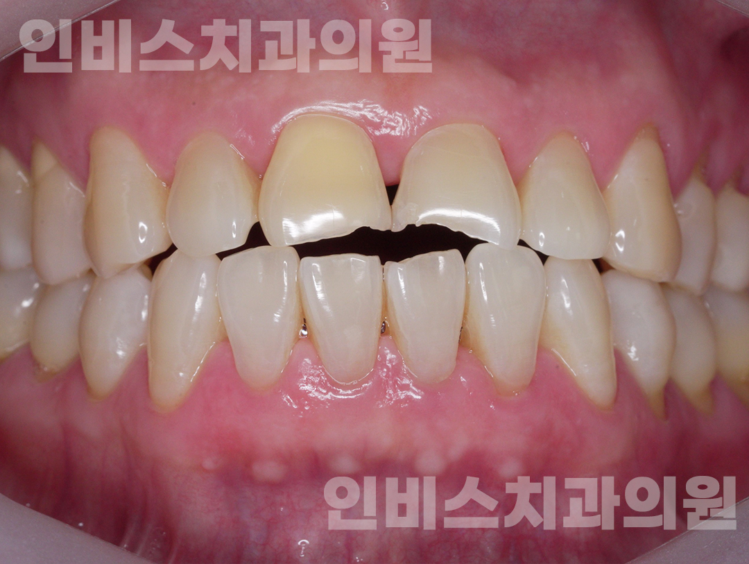 무삭제 라미네이트 전 2