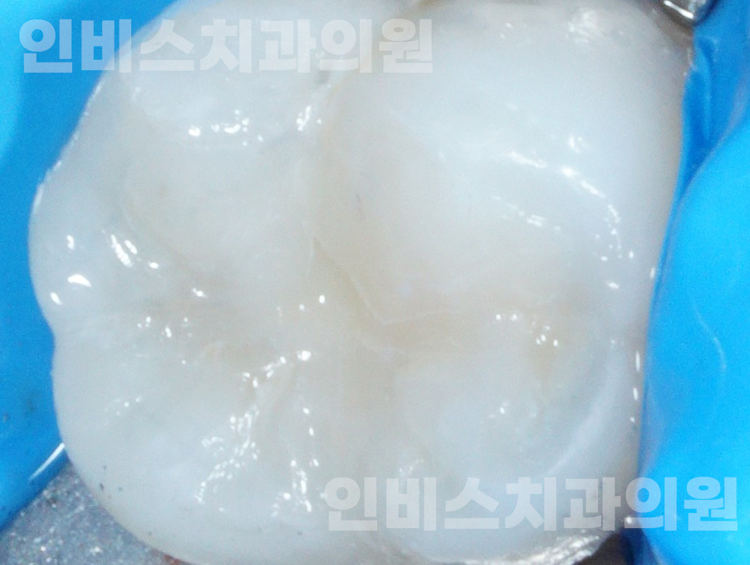 심미 보철 후 1