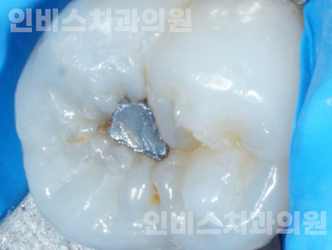 심미 보철 전 1